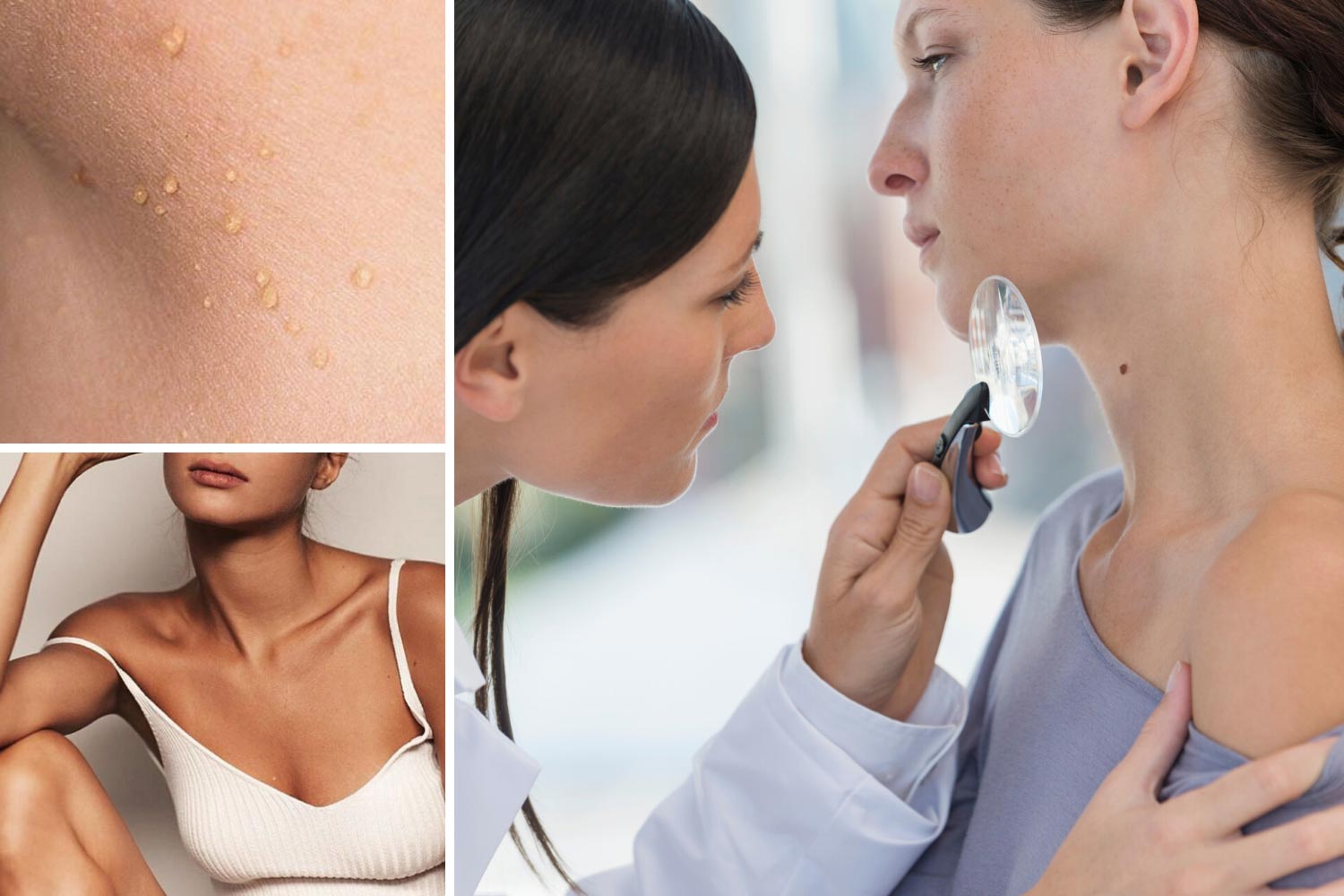 Папилломы на теле фото, удаление папиллом